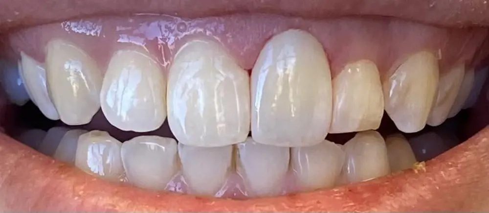 Same patient after dental crowns treatment