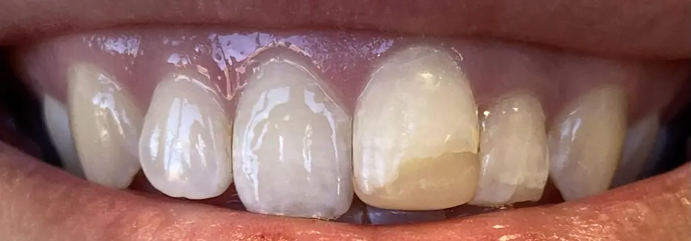 Patient before dental crowns treatment