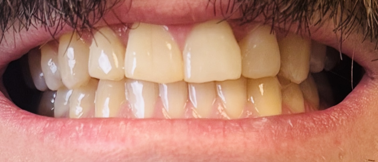 Same patient after invisalign treatment