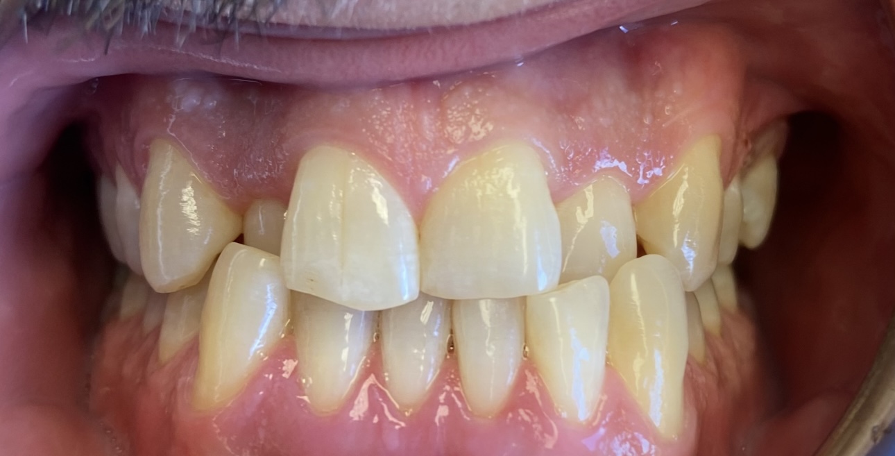 Patient before invisalign treatment