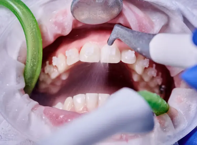 Illustrative image of a dental cleaning